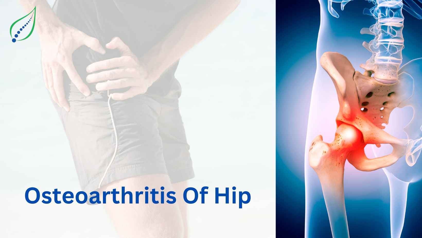 Osteoarthritis Of Hip